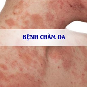 Bệnh Chàm Là Gì? Tìm Hiểu Về Bệnh Chàm Là Gì?