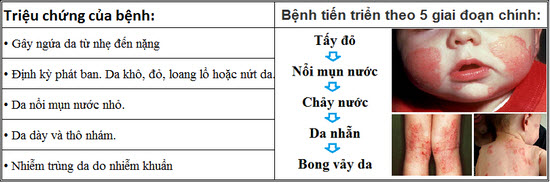 Bệnh Eczema Là Gì? Tìm Hiểu Về Bệnh Eczema Là Gì?