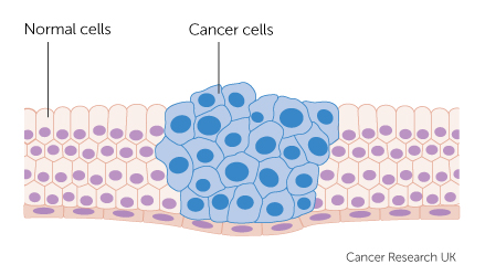 Cancer là gì?