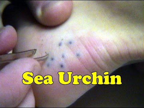 Cầu Gai Là Gì? Tìm Hiểu Về Cầu Gai Là Gì?
