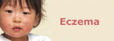 Bệnh Eczema Là Gì? Tìm Hiểu Về Bệnh Eczema Là Gì?