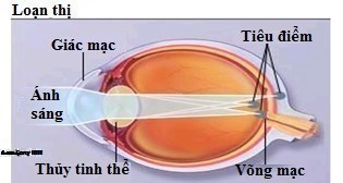 Loạn thị là gì và những tác hại của bệnh loạn thị gây ra?