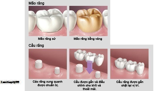 Mão Răng Là Gì? Tìm Hiểu Về Mão Răng Là Gì?