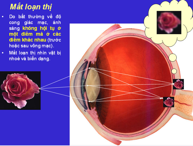 Loạn thị là gì và những tác hại của bệnh loạn thị gây ra?