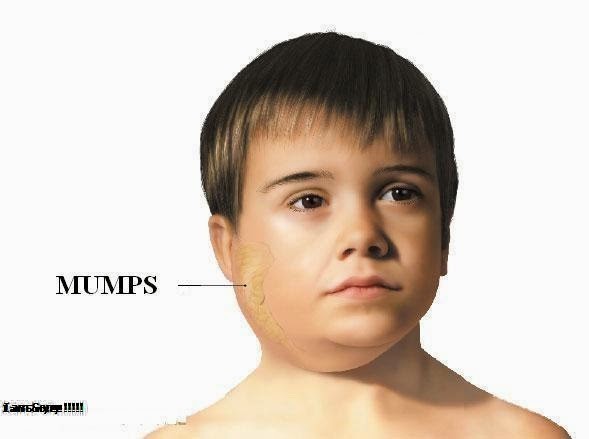 Mumps Là Gì? Tìm Hiểu Về Mumps Là Gì?
