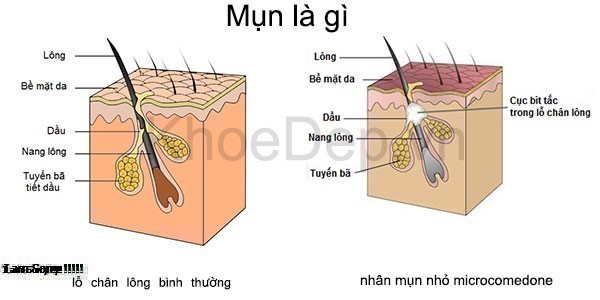 Mụn Là Gì? Tìm Hiểu Về Mụn Là Gì?