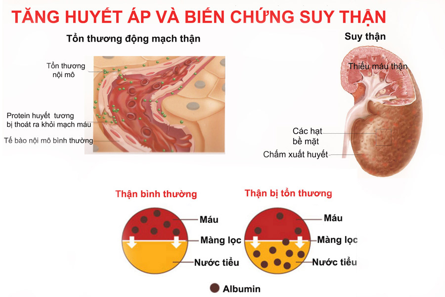 Suy Thận Là Gì? Tìm Hiểu Về Suy Thận Là Gì?