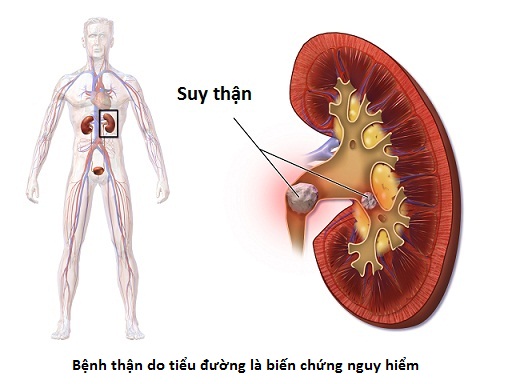 Suy Thận Là Gì? Tìm Hiểu Về Suy Thận Là Gì?