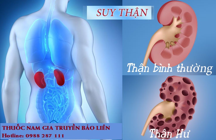 Suy Thận Là Gì? Tìm Hiểu Về Suy Thận Là Gì?