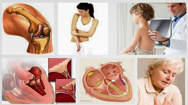 Bệnh Thấp Khớp Là Gì?Tìm Hiểu Về Bệnh Thấp Khớp Là Gì?