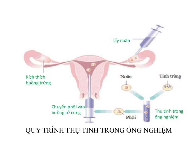 Tìm Hiểu Về Thụ Tinh Trong Ống Nghiệm Là Gì?