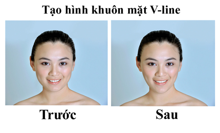 Mặt V-Line Là Gì? Tìm Hiểu Về Mặt V-Line Là Gì?