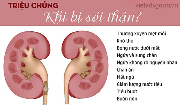 Nguyên Nhân và Triệu Chứng Của Bệnh Sỏi Thận Ảnh Hưởng Đến Sức Khỏe