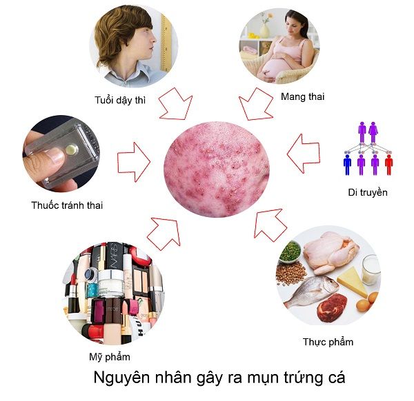 Nguyên nhân gây ra mụn trứng cá là do đâu?