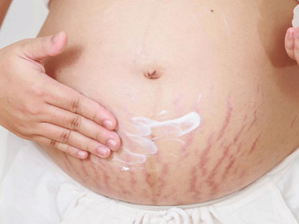4 mẹo trị rạn da cho bà bầu vừa đơn giản lại không ảnh hưởng đến thai