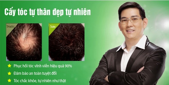 Bệnh Hói Đầu Là Gì? Cách Chữa Trị Nhanh Và Hiệu Quả