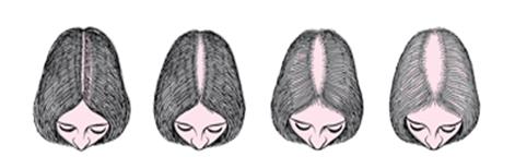 Bệnh Hói Đầu Là Gì? Cách Chữa Trị Nhanh Và Hiệu Quả