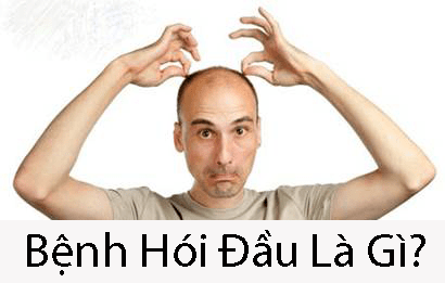 Bệnh Hói Đầu Là Gì? Cách Chữa Trị Nhanh Và Hiệu Quả
