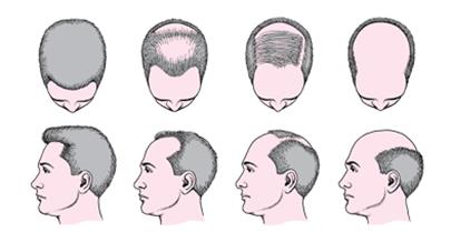 Bệnh Hói Đầu Là Gì? Cách Chữa Trị Nhanh Và Hiệu Quả