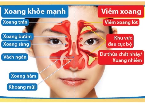 Bệnh Xoang Là Bệnh Gì? Cách Chữa Trị Khỏi Dứt Điểm