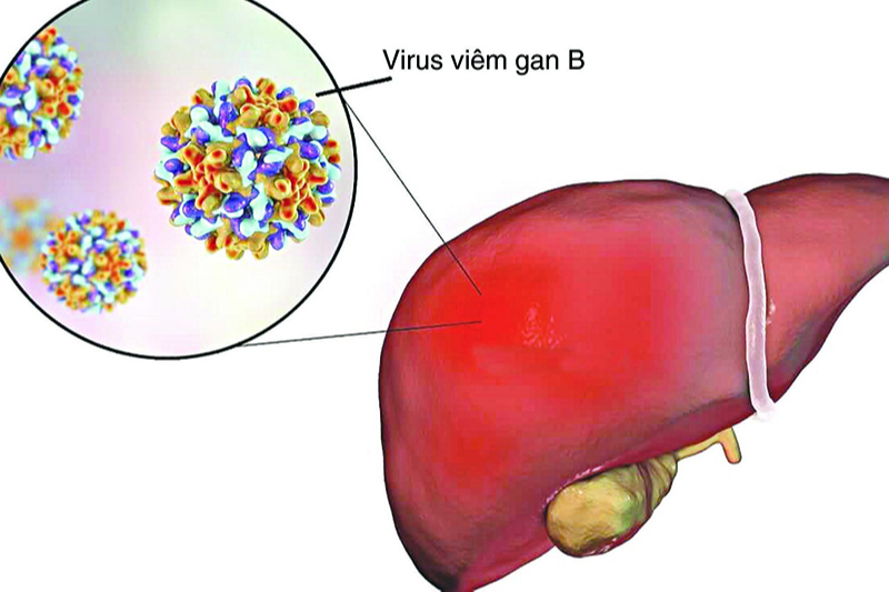 HBsAg là gì? Nên làm gì khi bị nghi nhiễm HBsAg