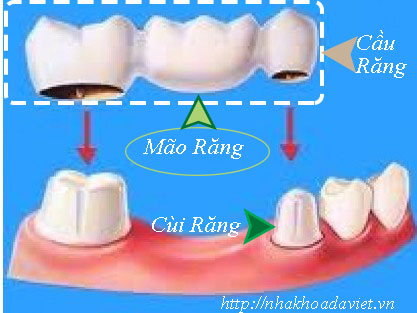 Mão Răng Là Gì? Tìm Hiểu Về Mão Răng Là Gì?